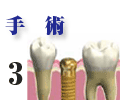 手術